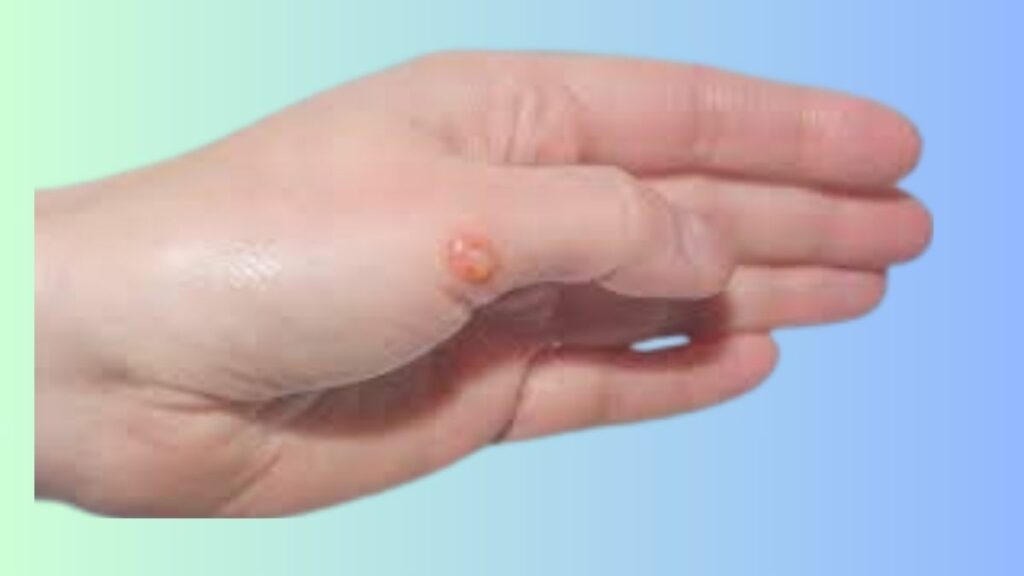 Blisterata Chemical Exposure